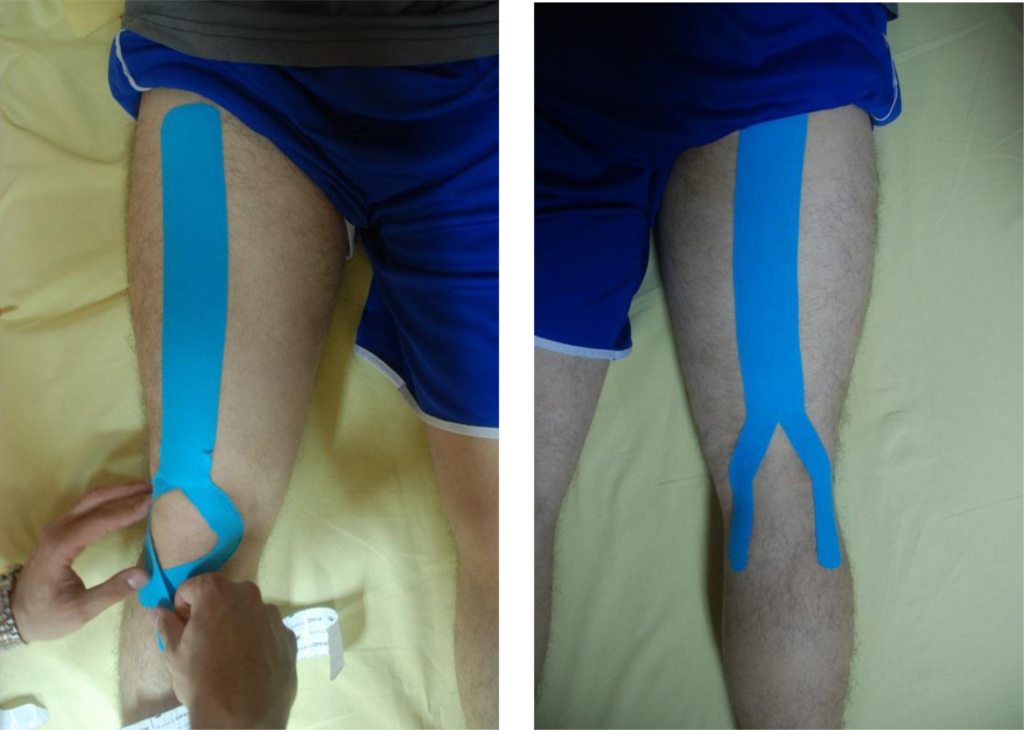 Osteoarthritis, Taping